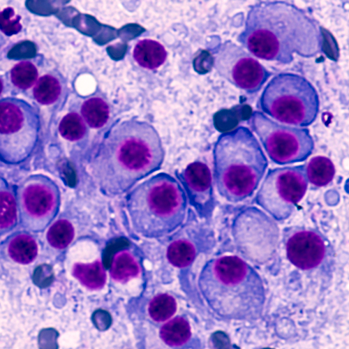Multiple Myeloma