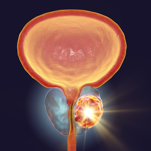 Prostate Cancer