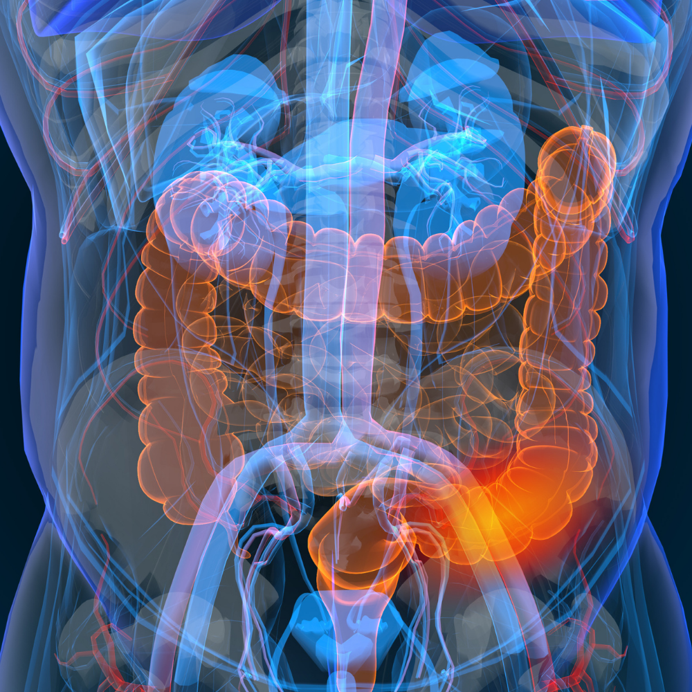 Medical Illustration of Male Anatomy - Colon Cancer