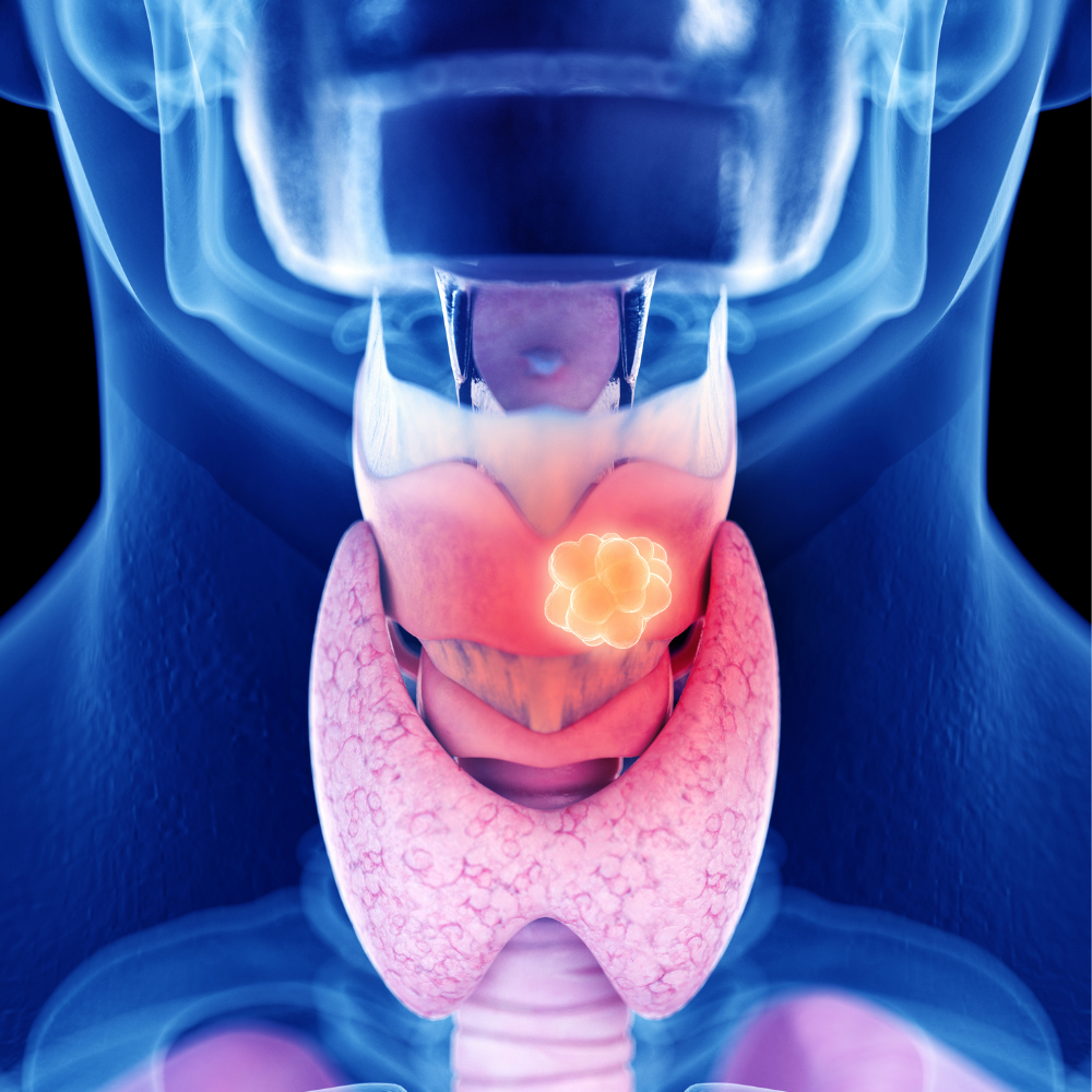 Head and Neck Cancer